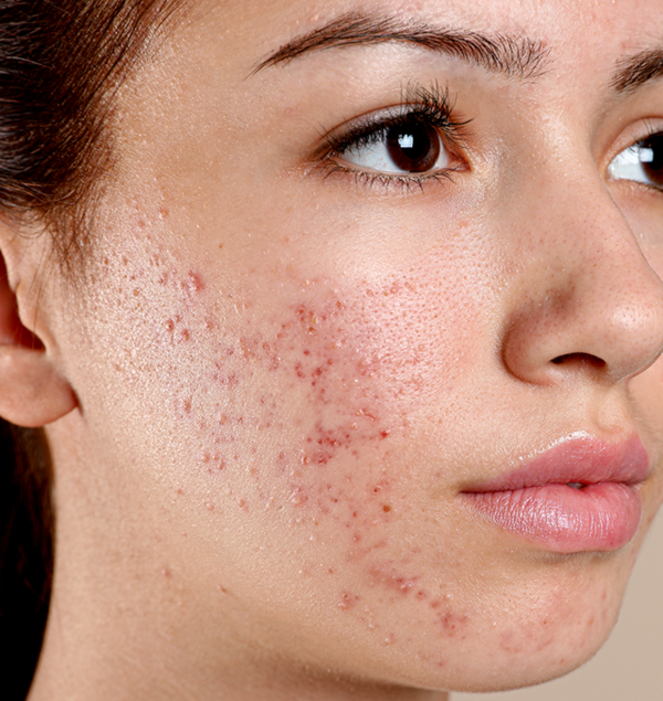 Cuidados com a pele com acne