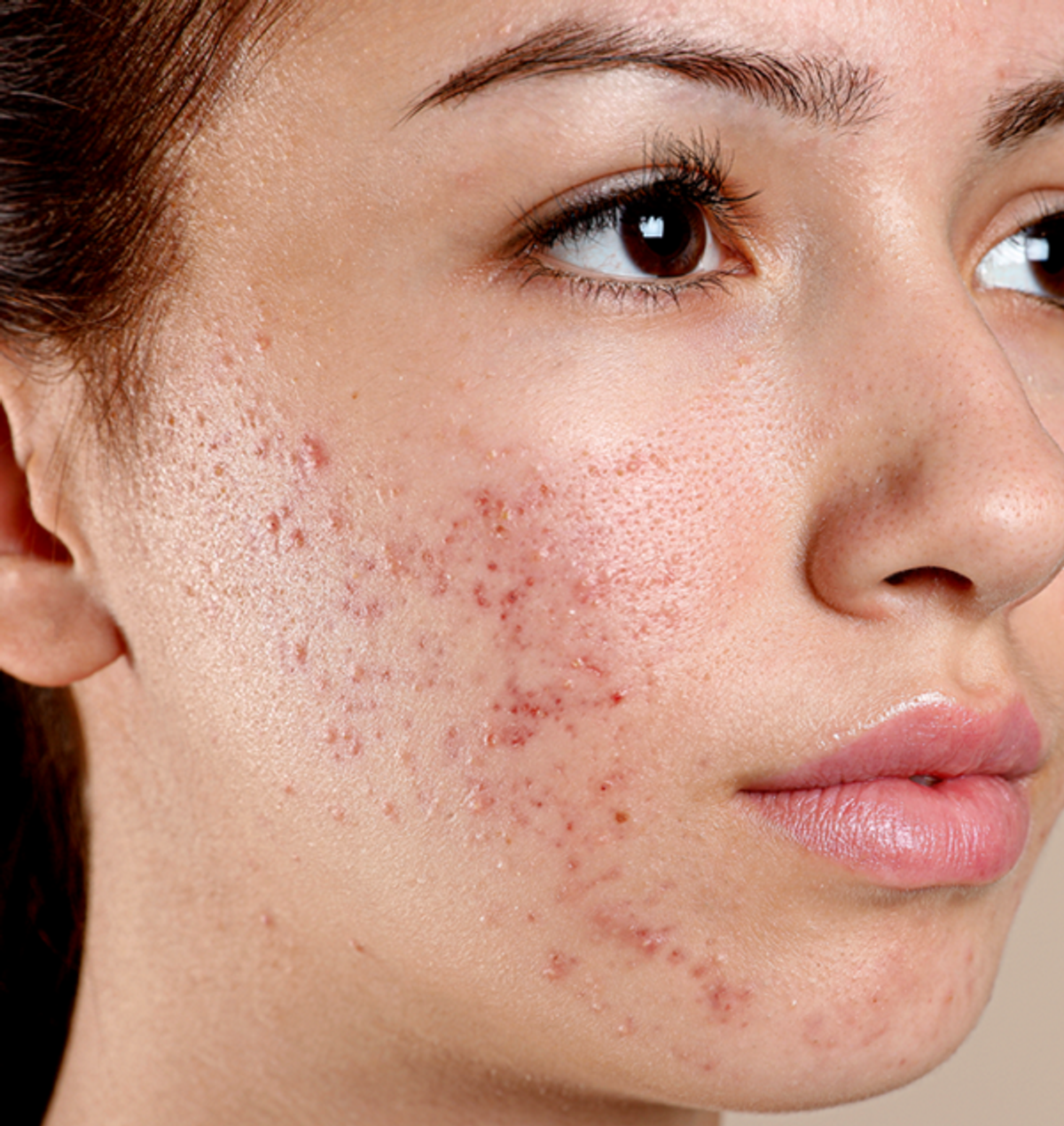 Acne huidverzorging