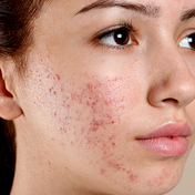Cuidado de la piel con acné