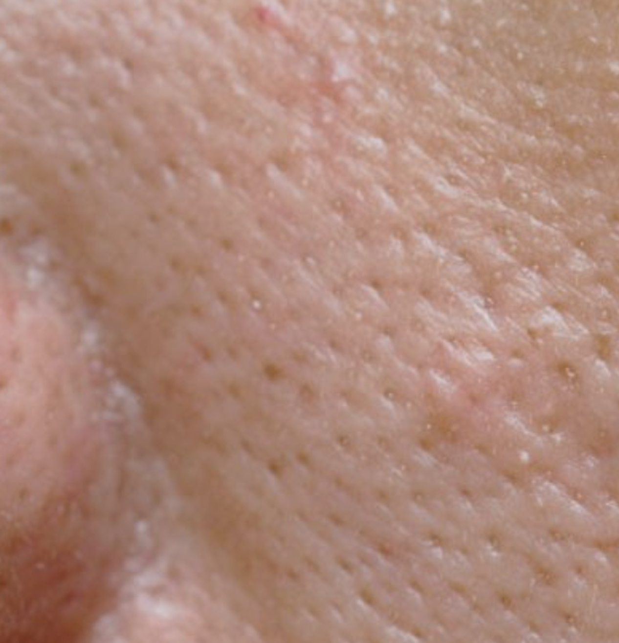 Comment réduire les pores dilatés