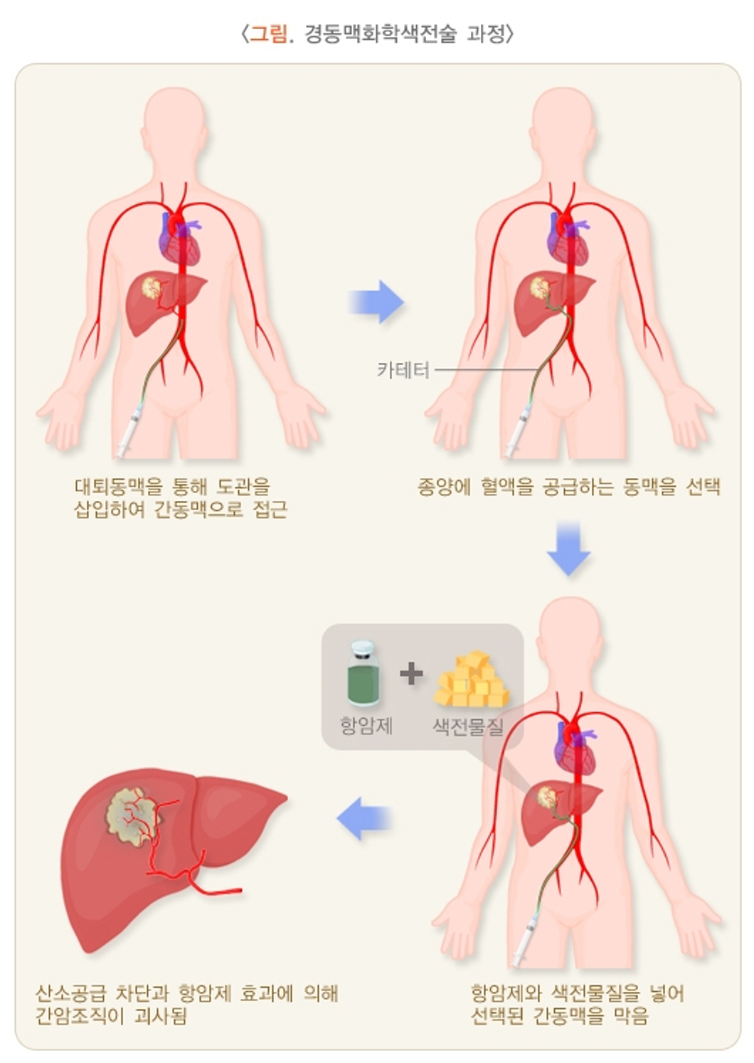頸動脈瘤とは？特徴、原因、症状、治療および手術方法