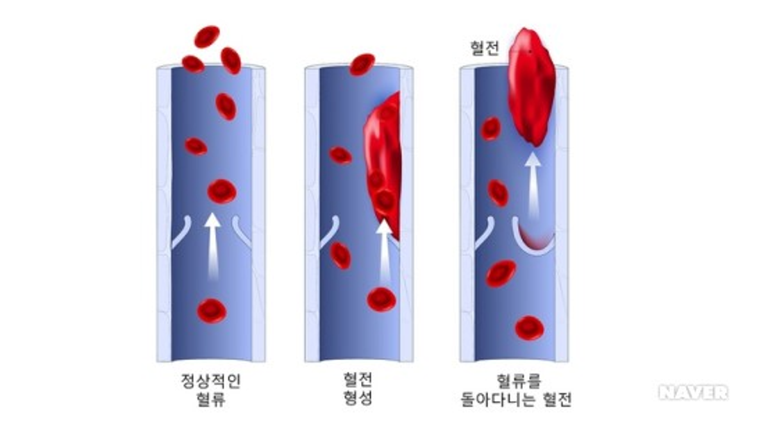 อาการ สาเหตุ การรักษา การผ่าตัด และการดูแลโรคลิ่มเลือดในหลอดเลือดแดงคาร์ออติด