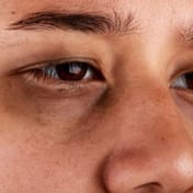 Ursachen von Augenringen