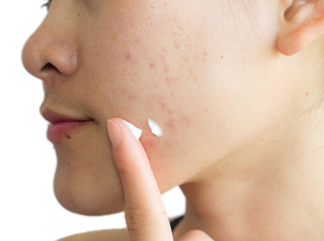 Acne Fucidine Madécasse