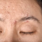 How to get rid of melasma and hyperpigmentation at home freckles