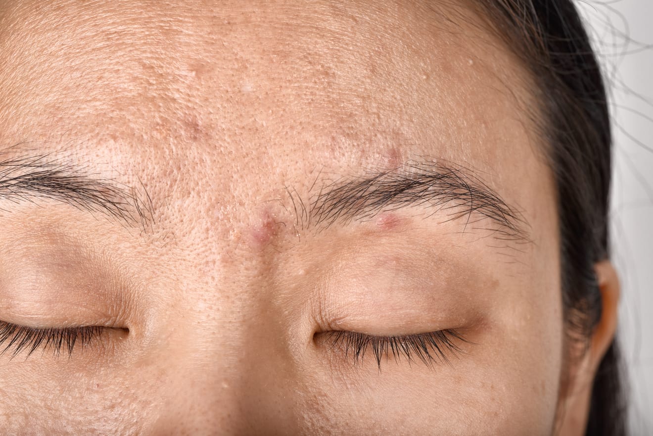 Cómo eliminar el melasma y la hiperpigmentación en casa pecas